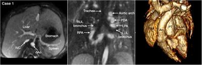 Contemporary sequential segmental approach to congenital heart disease using four-dimensional magnetic resonance imaging with ferumoxytol: an illustrated editorial